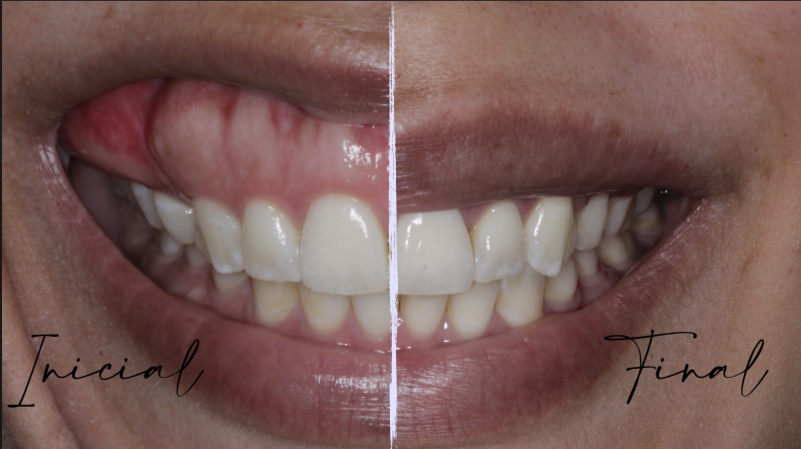 Antes e depois do tratamento do sorriso gengival
